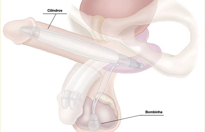 Representação gráfica do funcionamento do implante de prótese peniana inflável dentro do pênis. 