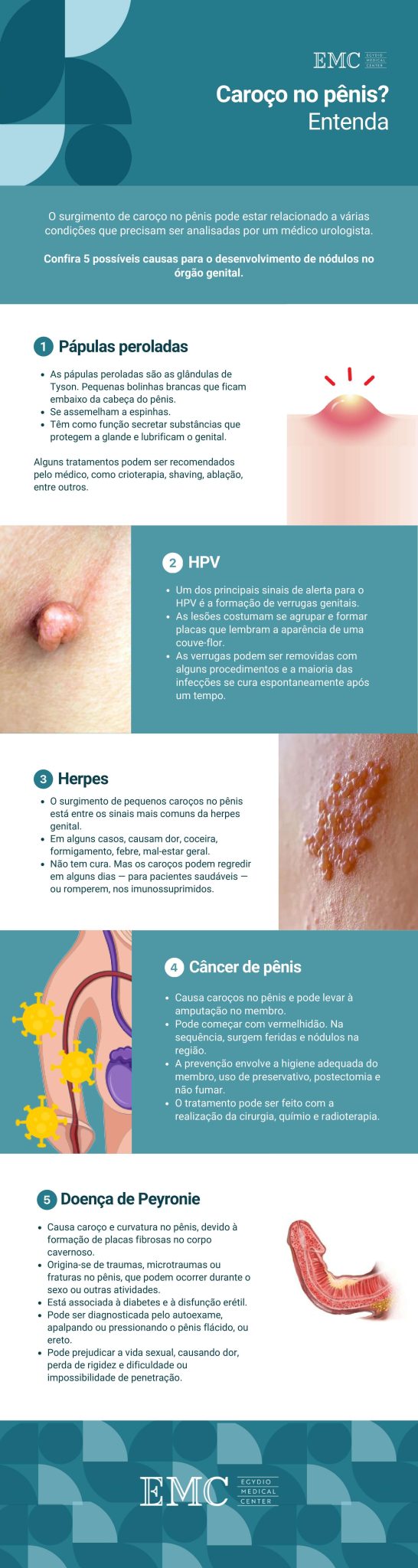 5 Causas do Caroço no Pênis e Tratamentos Indicados