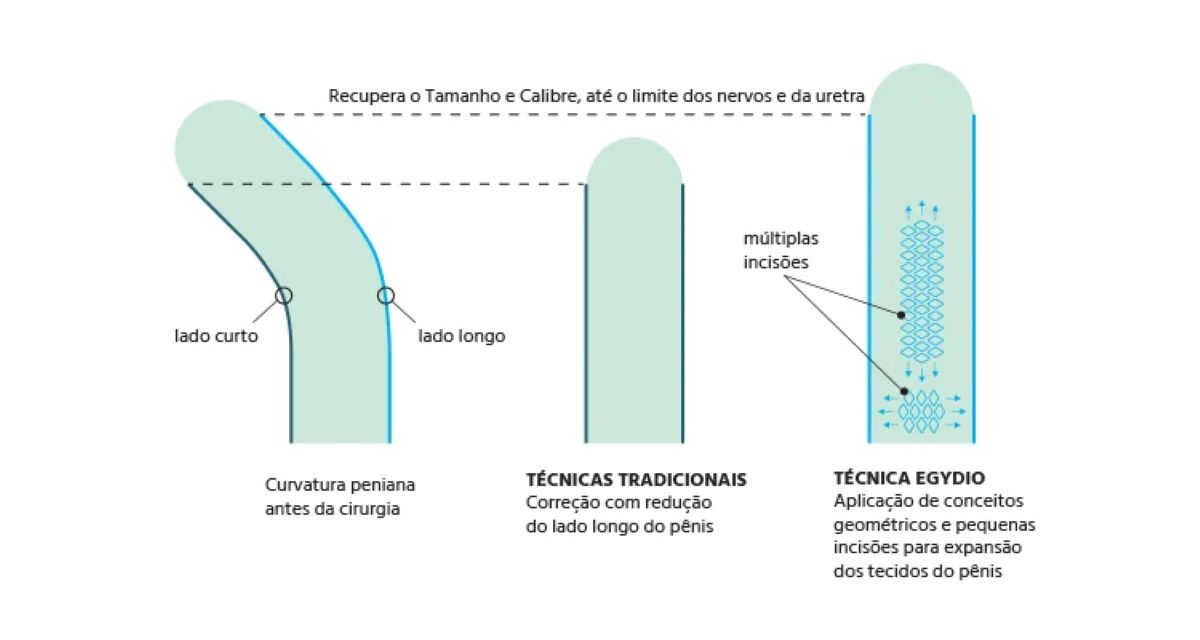 Ilustração da mecânica da cirurgia de Peyronie com Técnica Egydio,