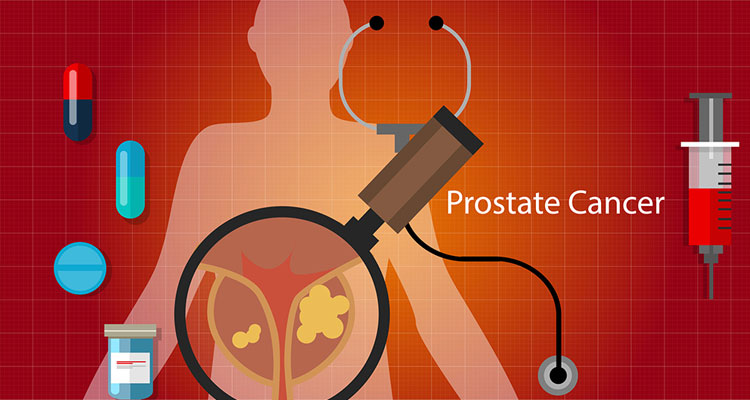 prostate-cancer-and-penile-prosthesis