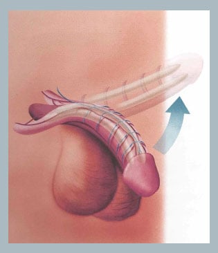Imagem representando como é o funcionamento da prótese peniana maleável