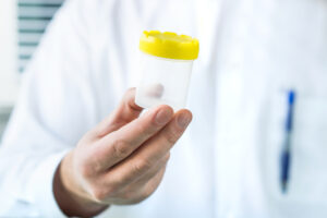 Homem segurando amostra de exame de espermograma vazio representando a anejaculação