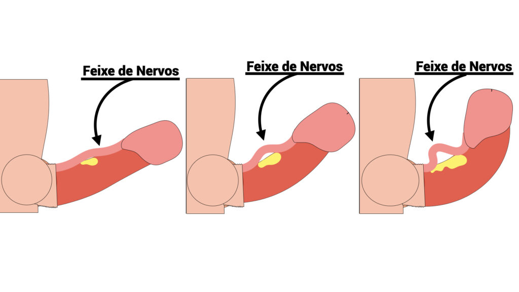 Desenho de três pênis com diferentes curvaturas causadas por fibrose peniana. Quanto maior é a fibrose, mais retraído os nervos ficam.