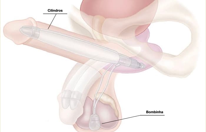 ilustração de prótese peniana inflável de 2 volumes mostrando cilindro aplicado no corpo do pênis e a bombinha nos testículos