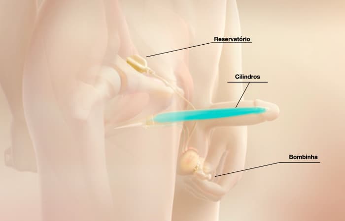 Illustration of a three-piece inflatable penile prosthesis showing cylinders placed in the shaft of the penis, a reservoir, and a pump.