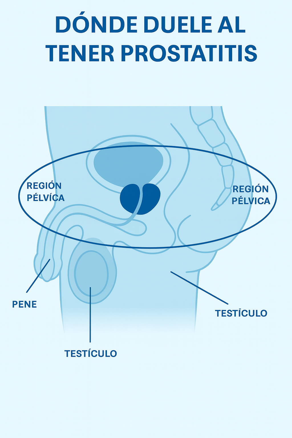 Infografía en tonos azules con una representación anatómica de la pelvis y marcaciones de las zonas donde hay dolor en la prostatitis: región pélvica, pene, testículos y perineo.