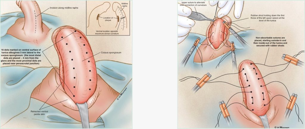 Illustration displaying the Lue technique