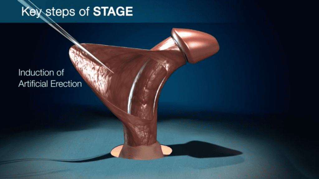 The first step of the STAGE Technique for correcting penile curvature is the induction of an erection, ensuring that the penis is prepared for the procedure.