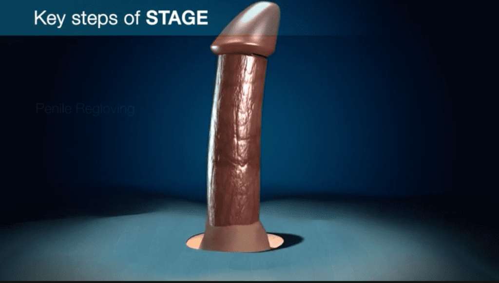 If the penis is aligned as desired, the procedure continues with the reinsertion of the skin or 'gloving' of the penis to finalize the correction.