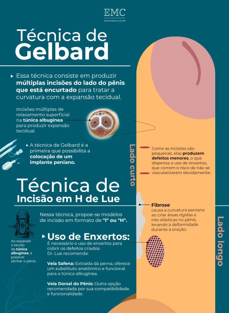 infográfico demonstrando as técnicas de gelbard e de lue para correção da curvatura peniana