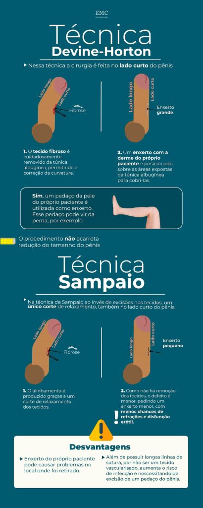 infográfico sobre técnicas de correção da curvatura peniana Devine-Horton e Sampaio