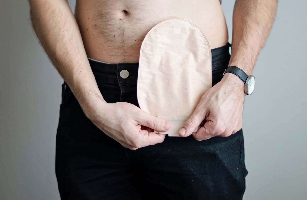 Tronco de homem branco, vestindo calças pretas e segurando uma bolsa de colostomia bege posicionada no abdômen representando se câncer colorretal tem cura