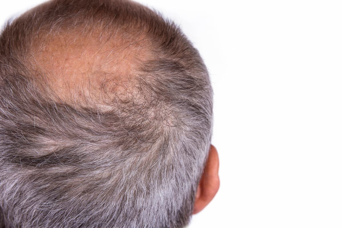 parte superior da cabeça de um homem com cabelos grisalhos, calvo, que enfrenta problemas de queda de cabelo e autoestima
