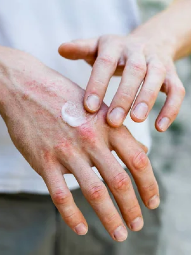 Pomada para Doença de Peyronie funciona? Conheça 3 tipos e entenda a eficácia de cada uma.