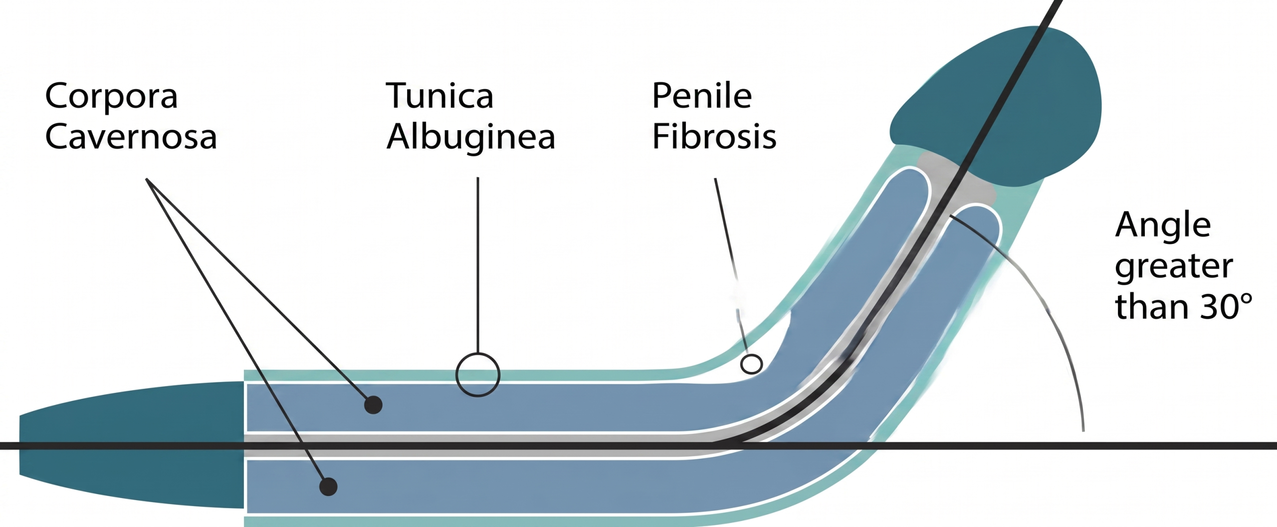 Infographic showing how penile fibrosis forms.