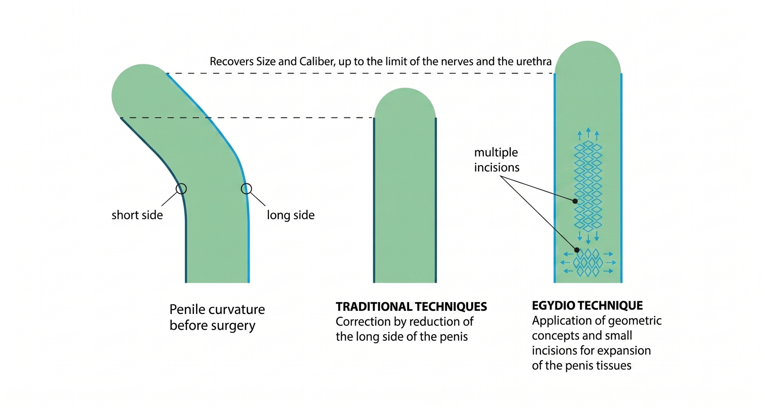 Imagem mostra técnica cirúrgica para descrever os benefícios da técnica egydio