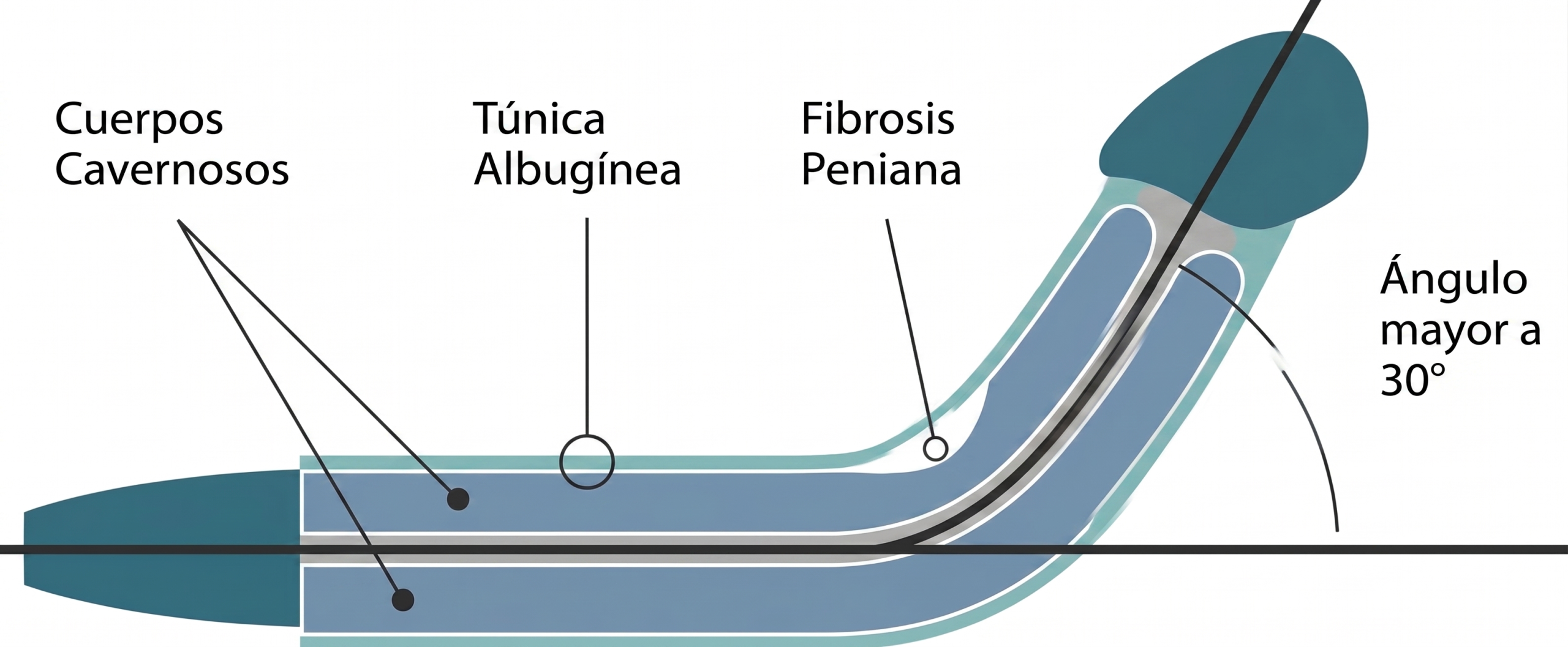 infográfico mostrando como acontece a formación de la fibrosis peniana