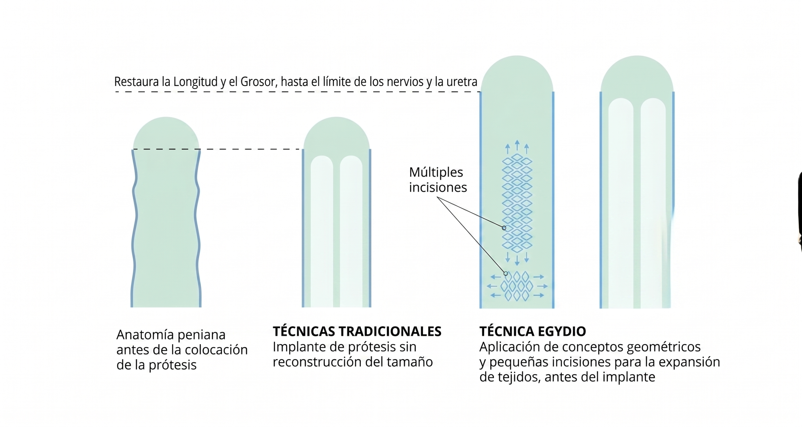 implantación de prótesis peniana con la Técnica Egydio